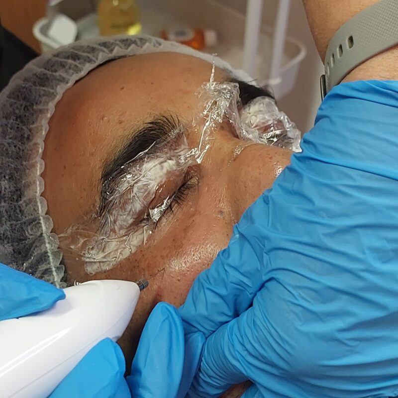Fibroblast