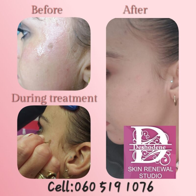 Dark spot removal