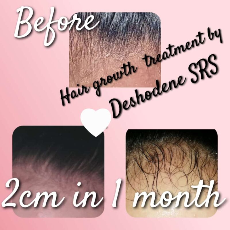 Hair Growth Treatment