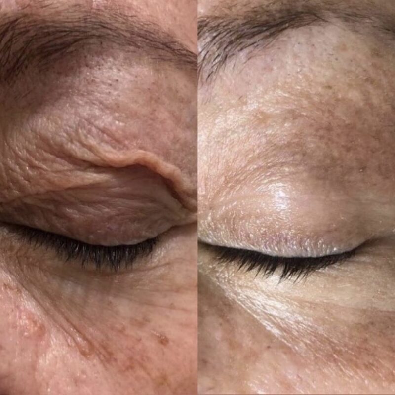 Plasma Fibroblast loose skin