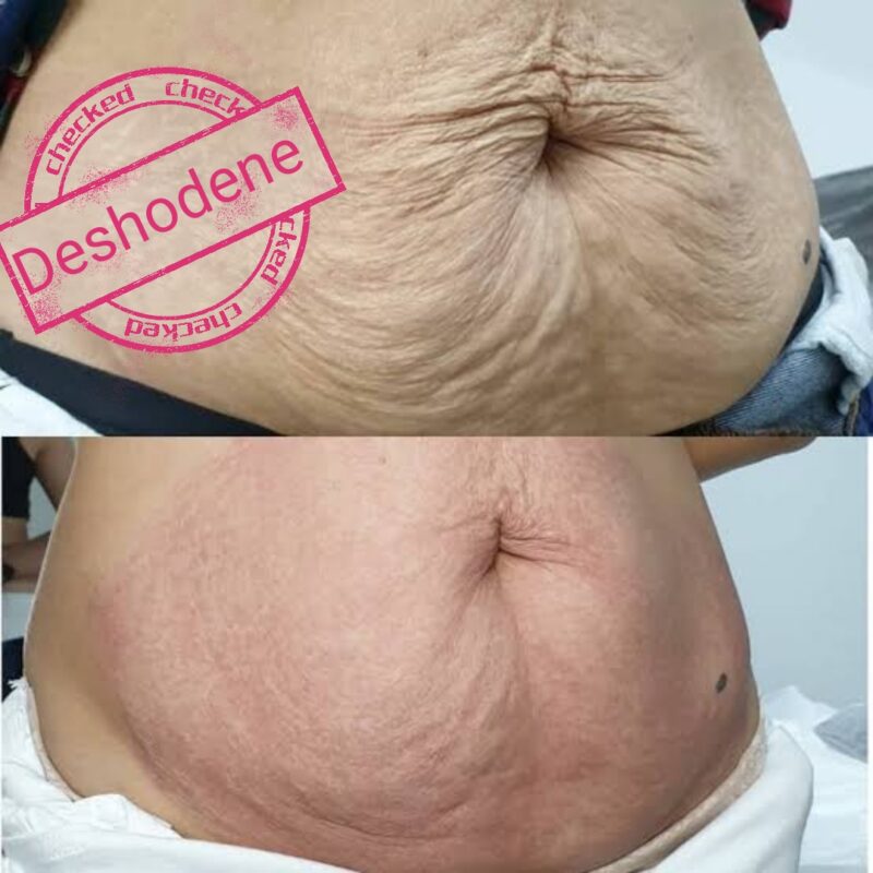Stretchmarks Firoblast 2