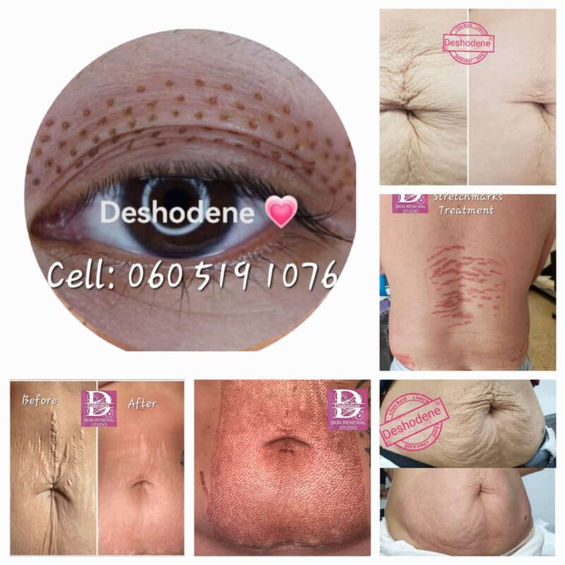Stretchmarks Firoblast